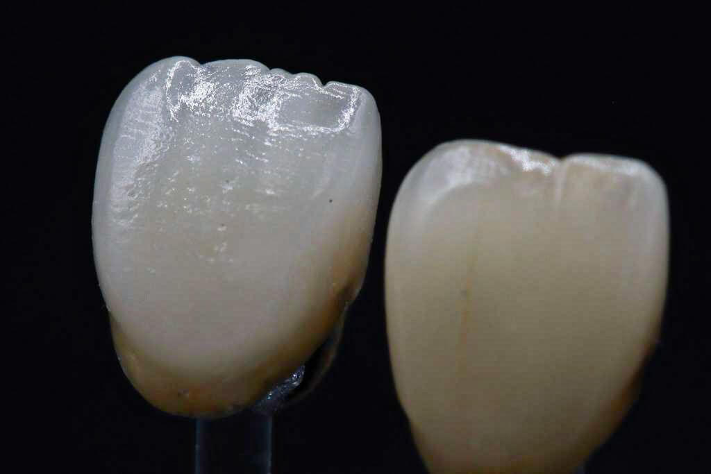 Implantatgestaltung zweier Zähne Implantatgestaltung zweier Zähne